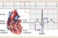 Kvíz v hodnocení křivky EKG u pacienta předávkovaného digitálisem